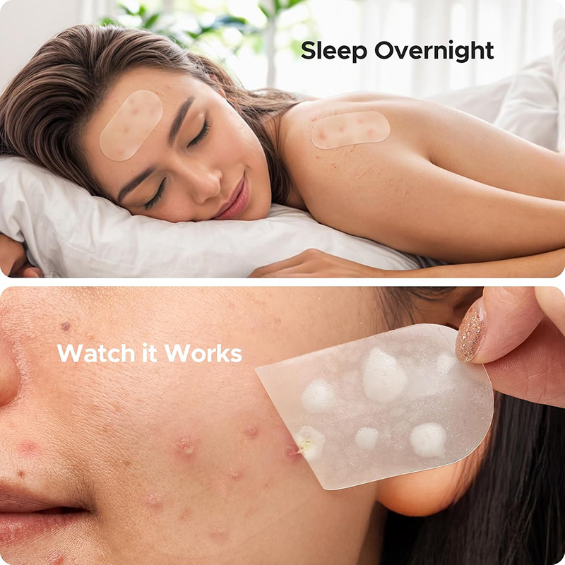 New 116Pcs Invisible Anti-Acne - đánh giá và giá Beauty And Makeup
